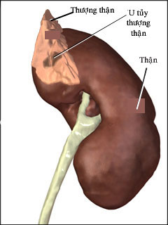 Bệnh u tủy thượng thận